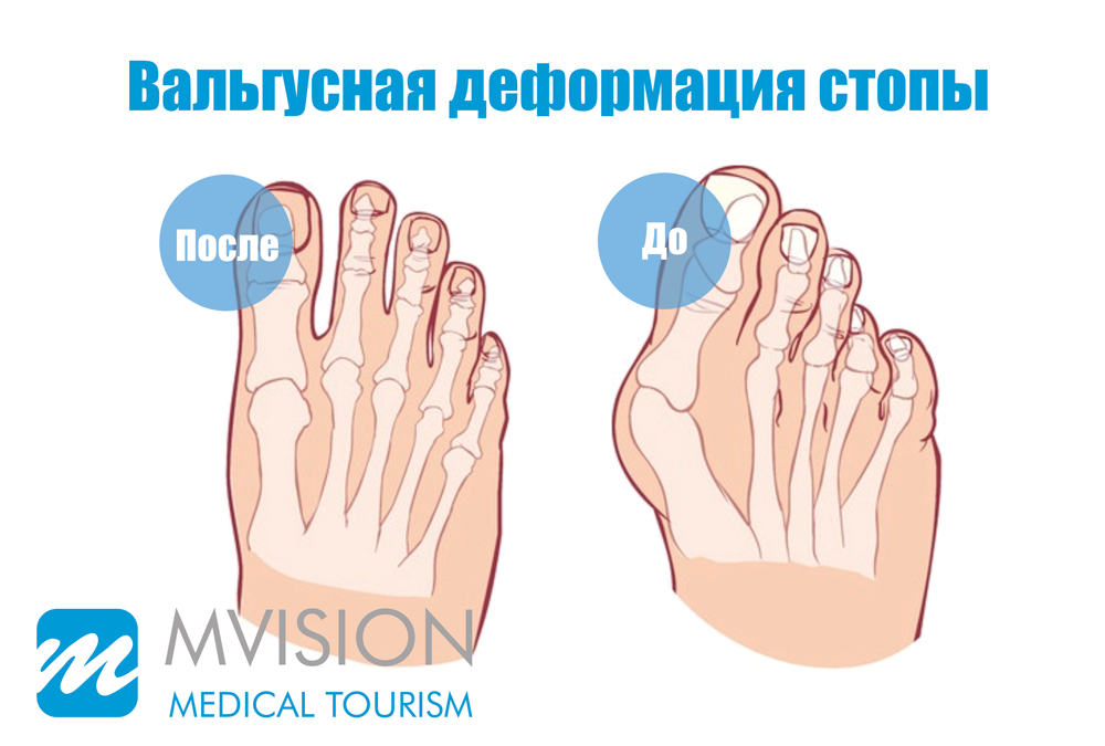 Деформация стопы код по мкб. Вальгусная деформация стопы. Массаж при вальгусной деформации стопы у детей. Вальгусная деформация стоп код по мкб 10.